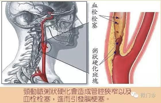 天冷了，十件事保護好你的心血管