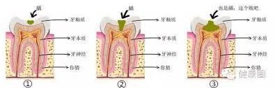 牙齒上黑色的東西到底是什麼，竟隱藏著巨大的隱患(圖)
